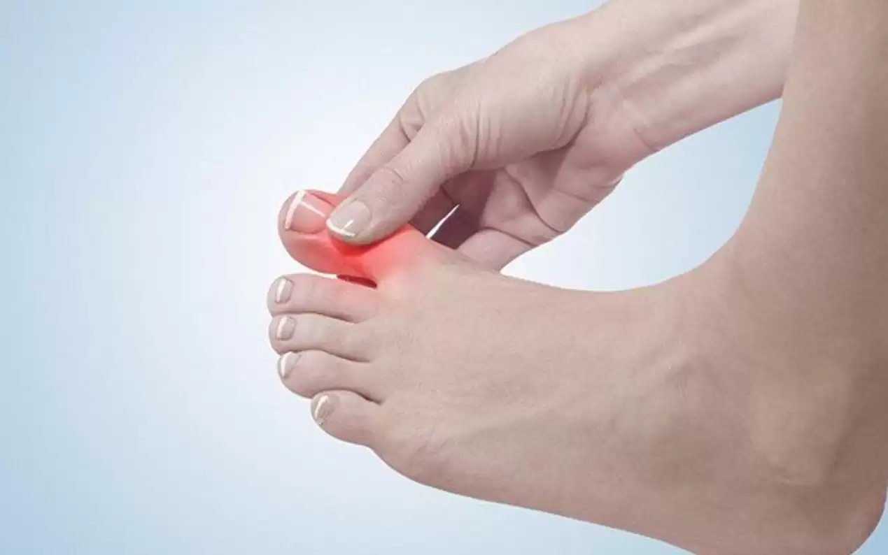 Bệnh Gout Hay Gặp ở Ngón Chân Trái